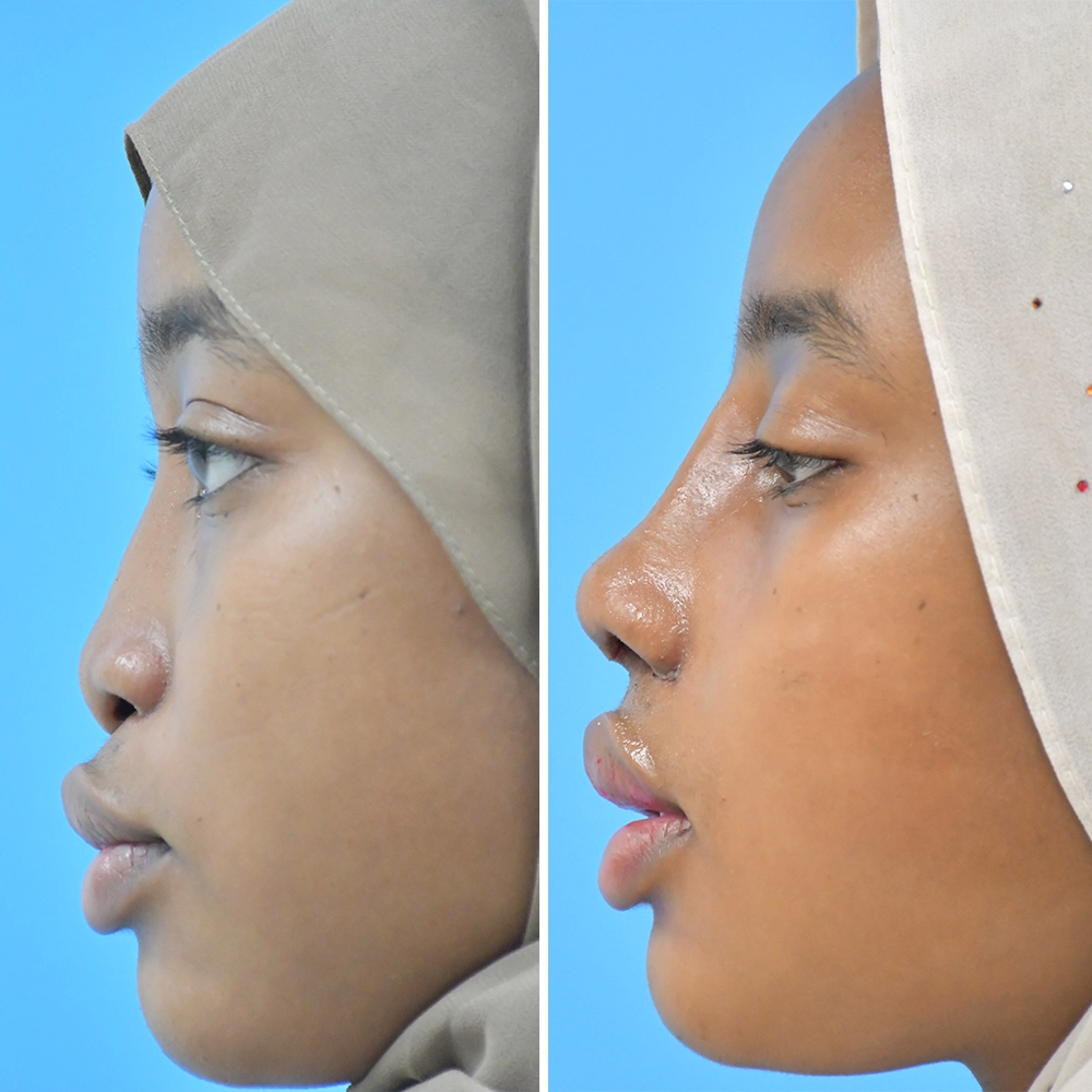 Ethnic Nose Job