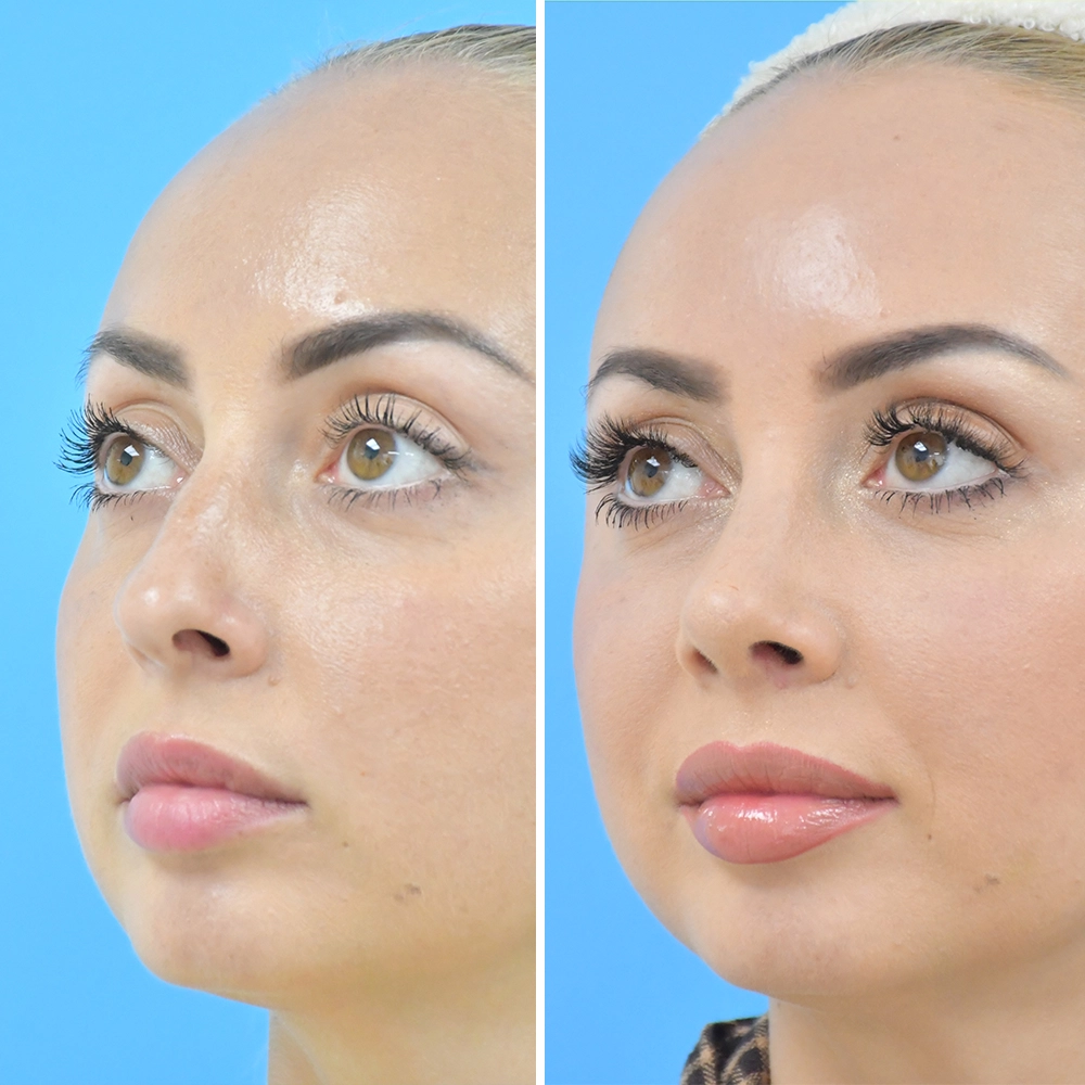 Natural Rhinoplasty