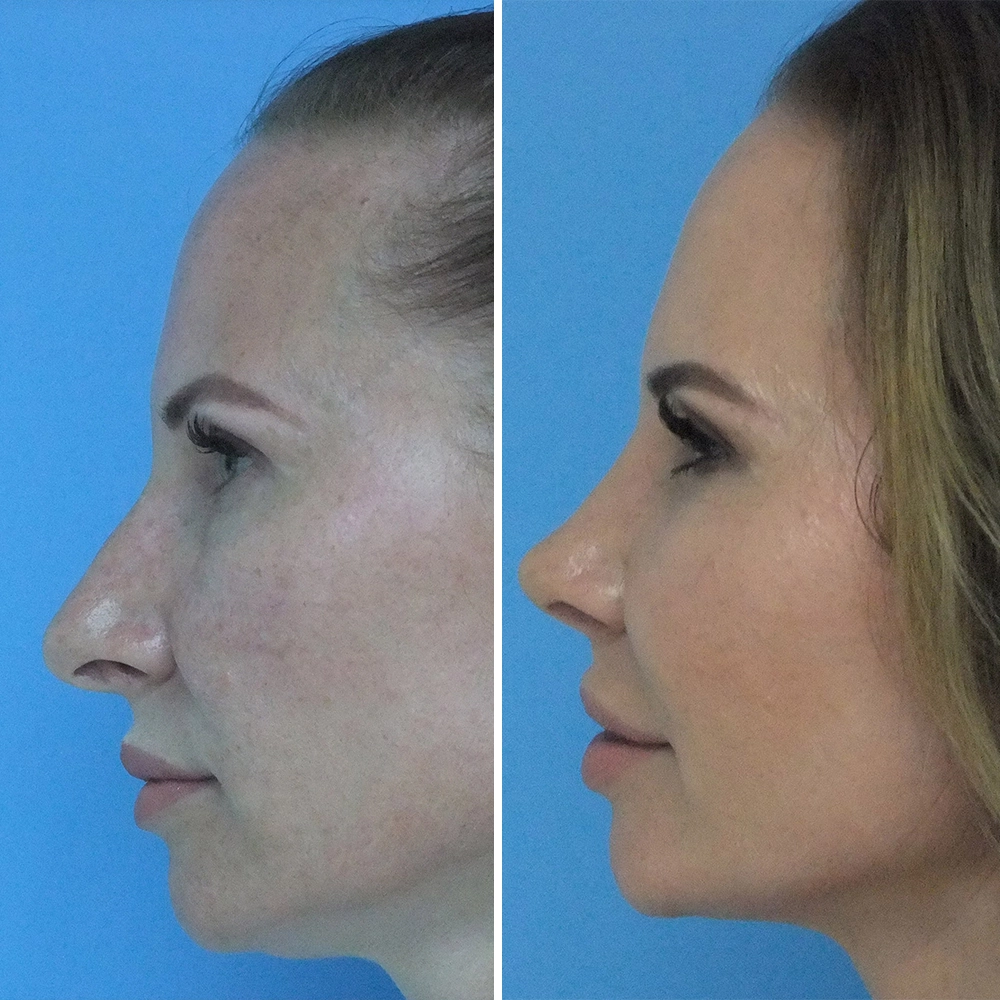 Natural Barbie Nose