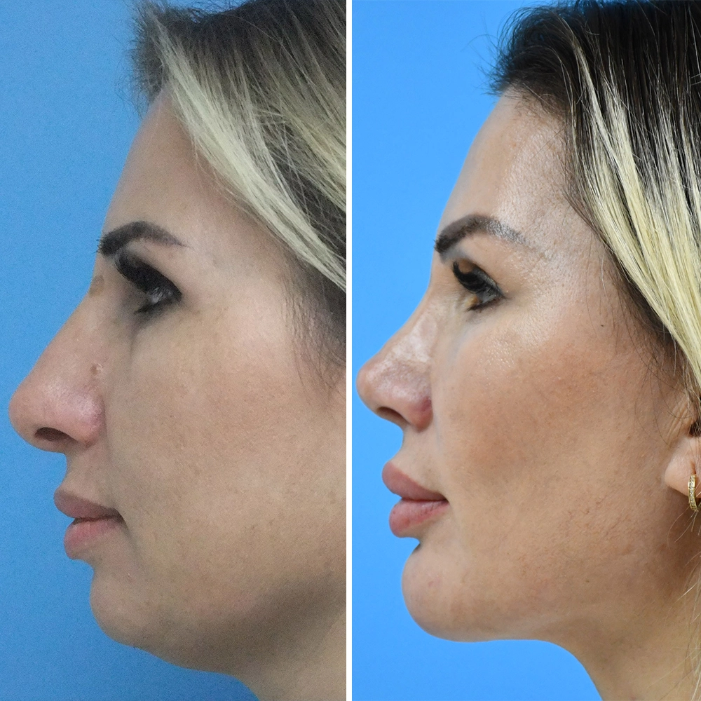 Rhinoplasty Long Term