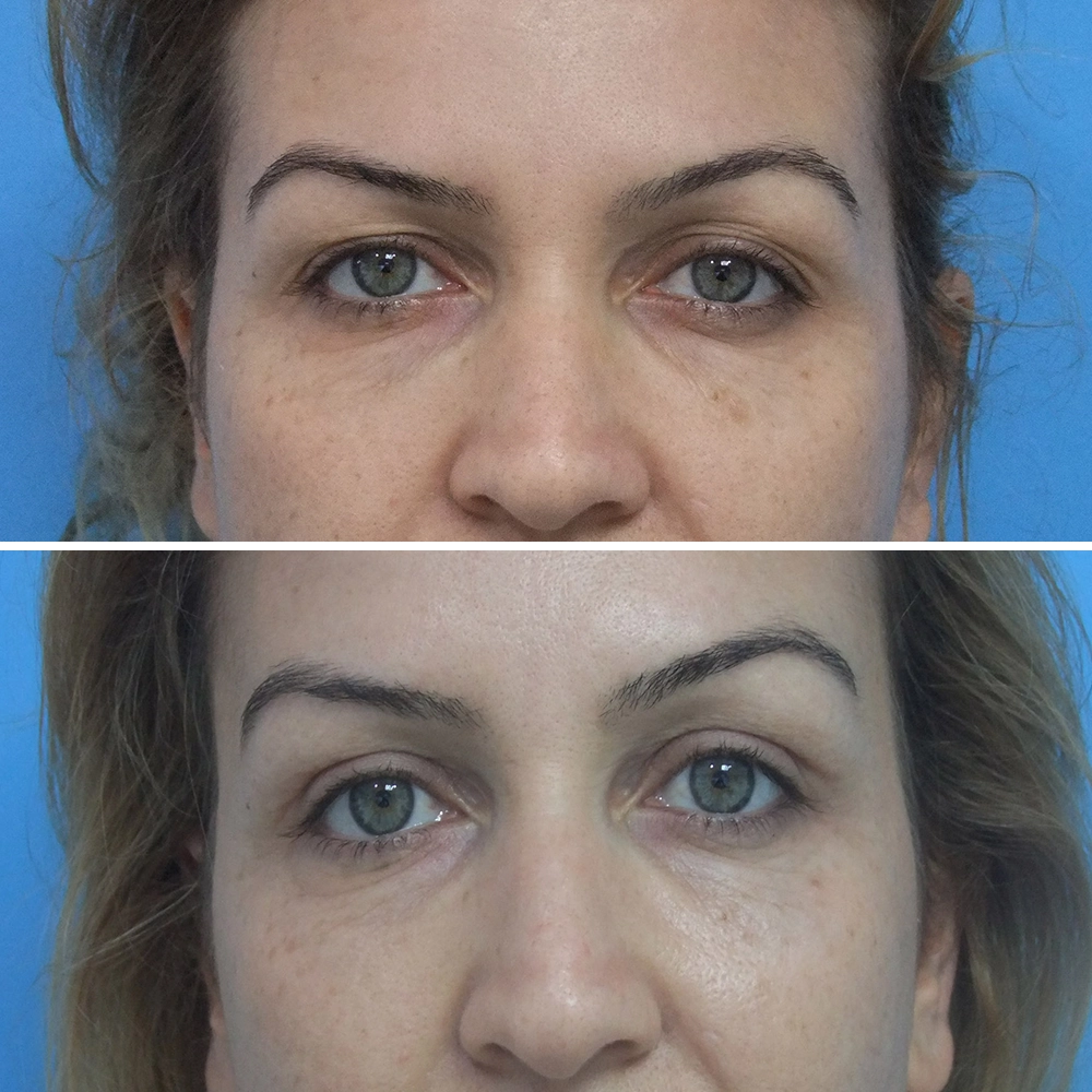 Rhinoplasty Patient