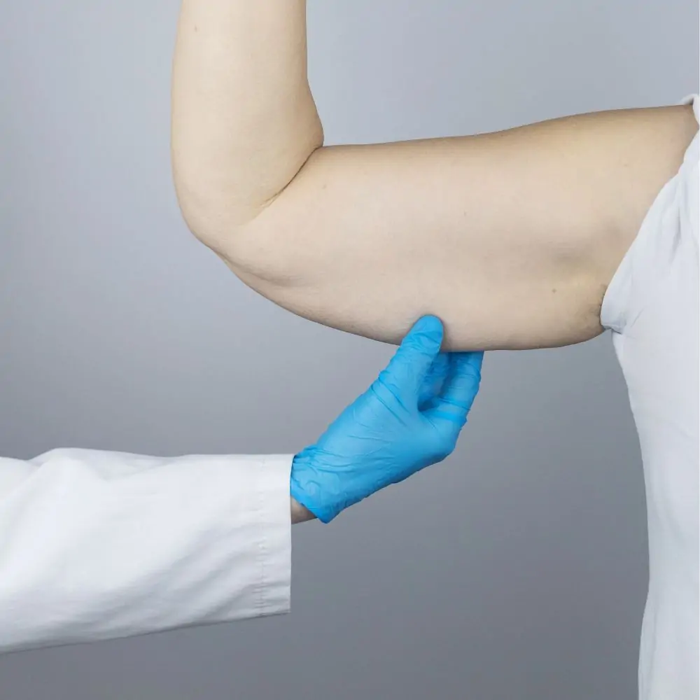 Arm Lift