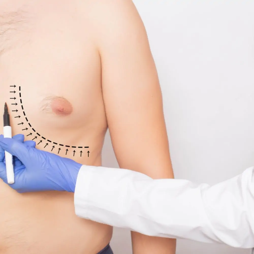 Gynecomastia