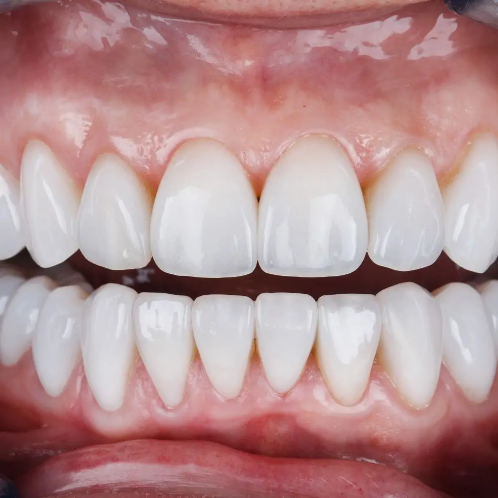 Laminate Veneers
